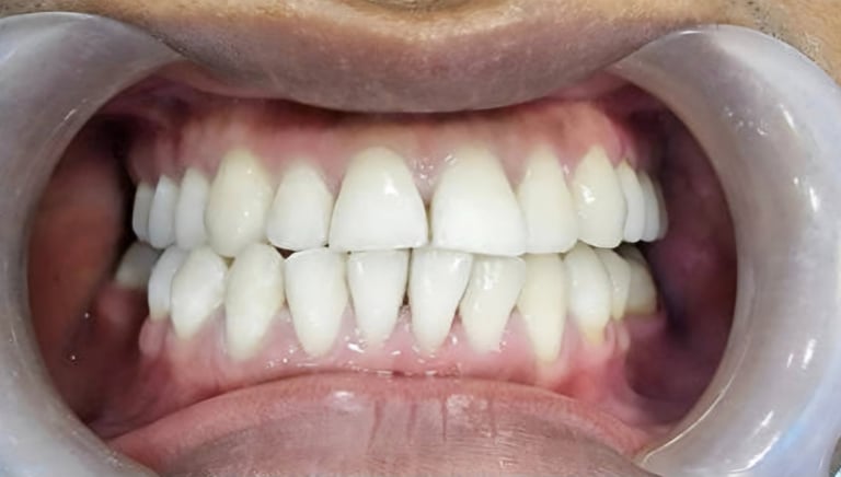 After whitening showing clean, lighter enamel tone at Shree Dental Care Shyamal Ahmedabad