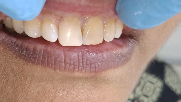 Tooth colored filling after replacing old filling for improved aesthetics in Shyamal Ahmedabad