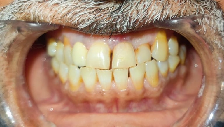 after tooth colored filling in front tooth showing healthy tooth at shree dental shyamal ahmedabad