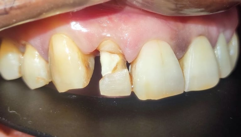 before tooth colored filling in front tooth at shyamal ahmedabad