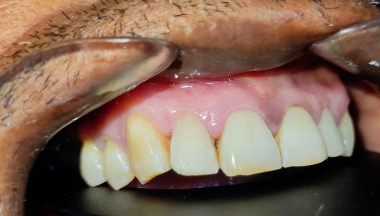 after tooth colored filling in front tooth at shyamal ahmedabad shree dental care