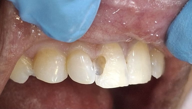 Old discolored dental filling before replacement with tooth colored filling in Shyamal Ahmedabad