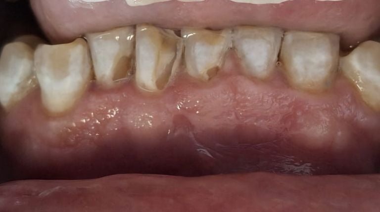 Broken front tooth edge before tooth colored filling restoration in Shyamal Ahmedabad