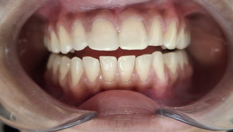 Restored broken tooth using tooth colored filling with natural shape in Shyamal Ahmedabad