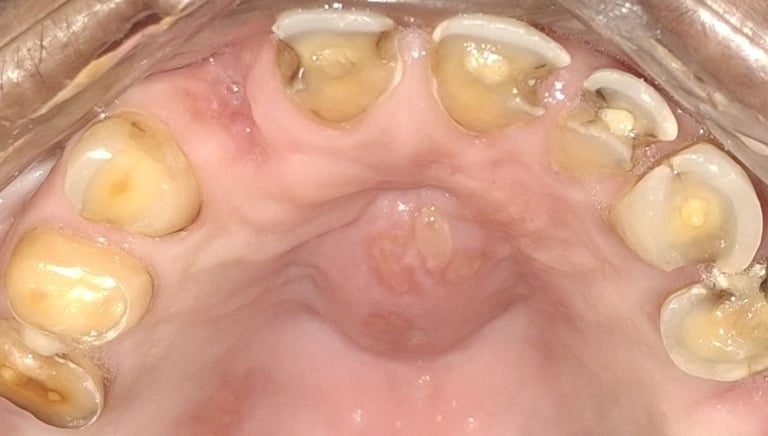 loss of tooth infection pain and palatal swelling failed filling at shree dental care