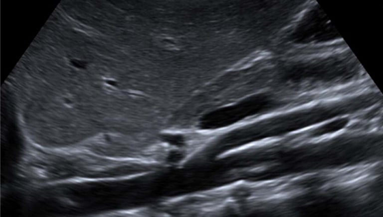 abdominal-aortic-ultrasound-hialeah-florida-luxury-therapy-center.jpg