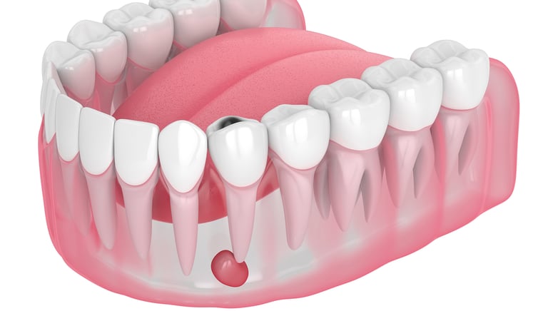an image showing teeth with abscess