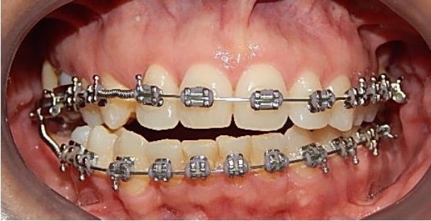 Sonrisa con brackets en tratamiento incompleto