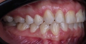 Sonrisa despues de terminar tratamiento de ortodoncia