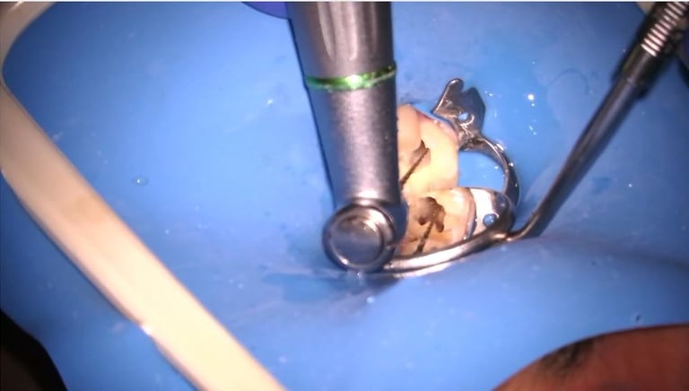 A high-speed dental drill performing a root canal procedure on a tooth isolated by a blue rubber dam.