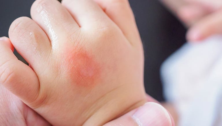 Close-up of a red, swollen ant bite on a baby's hand showing a localized skin reaction.
