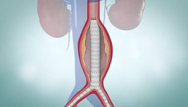 endovascular aortic aneurysm repair