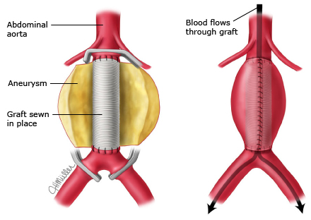 open surgical aortic aneurysm repair