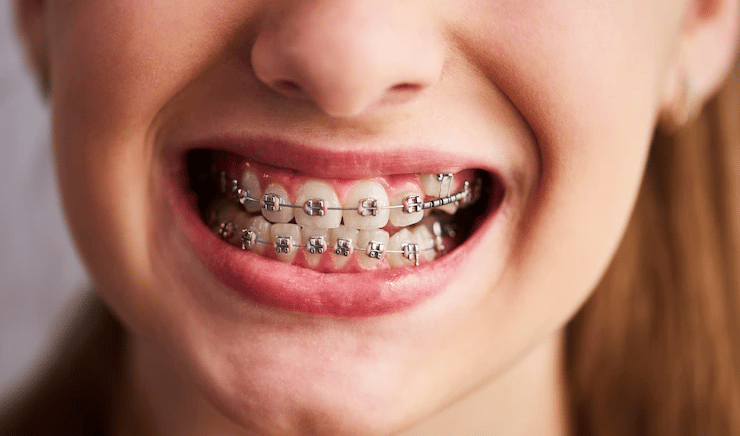 aparelho dentário 