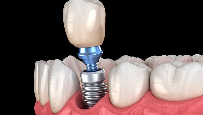 ilustração implante dentário
