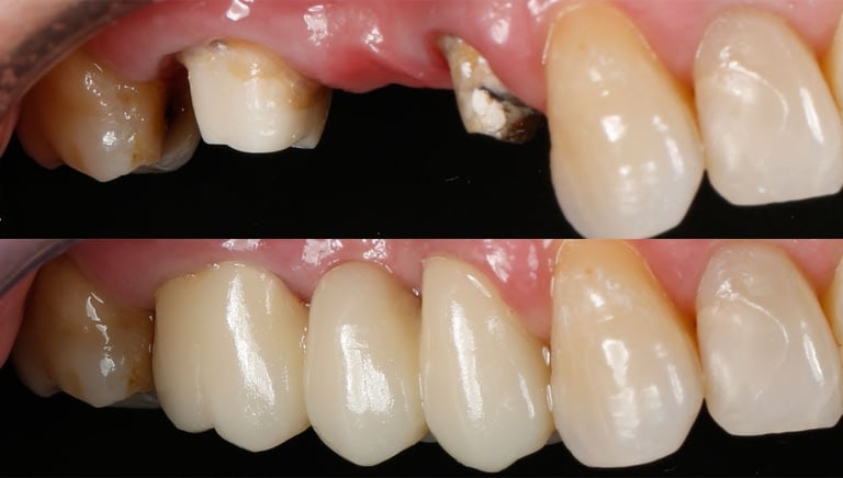 foto prótese fixa sobre dentes