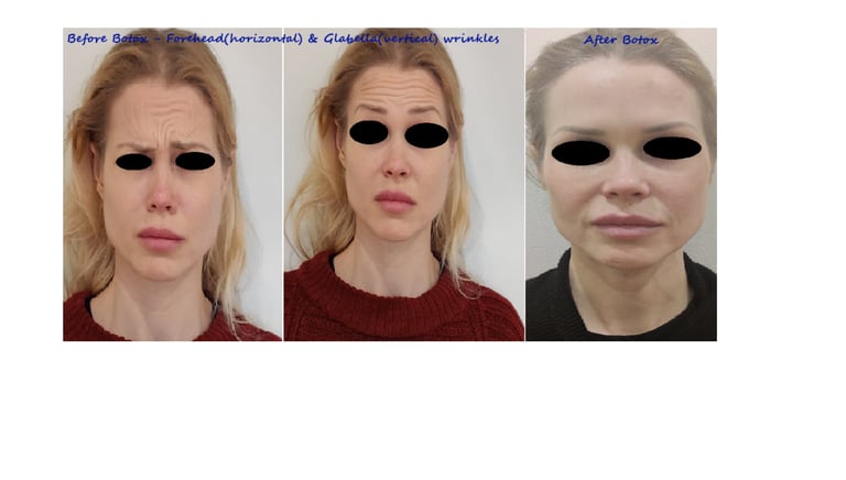 Botox before and after. Botox for upper face to reduce wrinkles on forehead & between eyebrows.