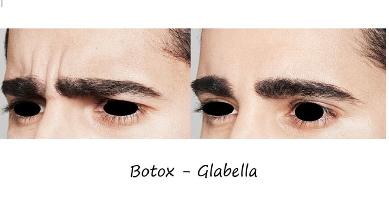 Före- & efterbild botox glabella – slätare bekymmersrynkor och avslappnat, harmoniskt utseende.