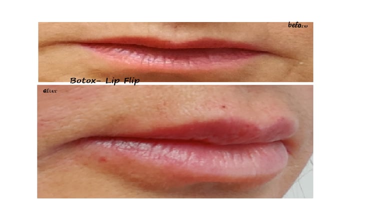 Botox before and after photo. Lip Flip Botox for fuller lips & reduction of wrinkles around lips.