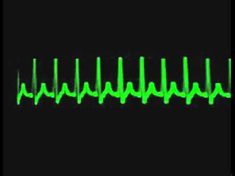 taquicardias cardiologo en morelia