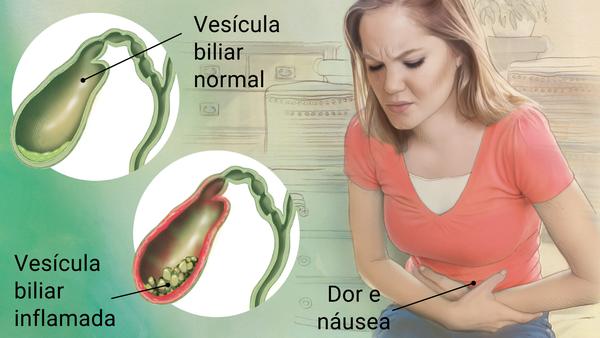 Colecistite aguda. Vesícula inflamada