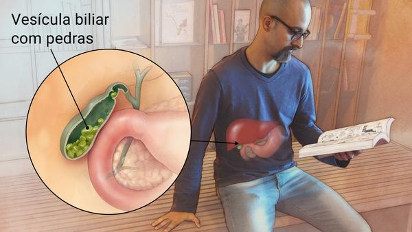 Pedra na vesícula. Gallstones