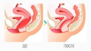 фото схематичне зображення до та післи лазерного омолодження