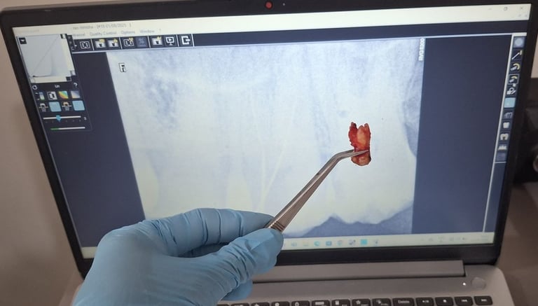 very big upper third molar removed with proper technique at shree dental care near shyamal