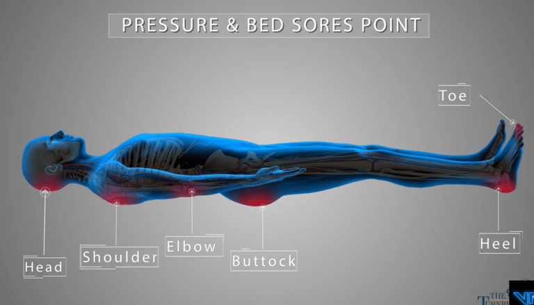 Pressure & Bed Sores Medical Animation