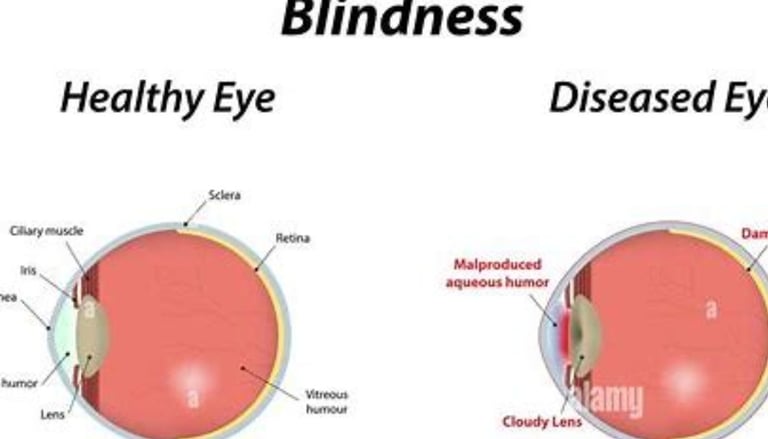 diseased eye