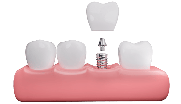 implantes dentales en las palmas de gran canaria visita gratuita