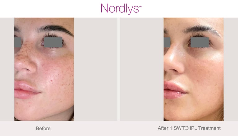 skin smoothing and texture improvement after professional treatment in Hamilton clinic