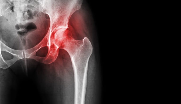 Dr.Rajinikanth's ortho clinic avascular necrosis(AVN)