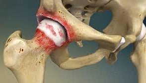 Dr.Rajinikanth's ortho clinic arthritis/ osteoarthritis of hip