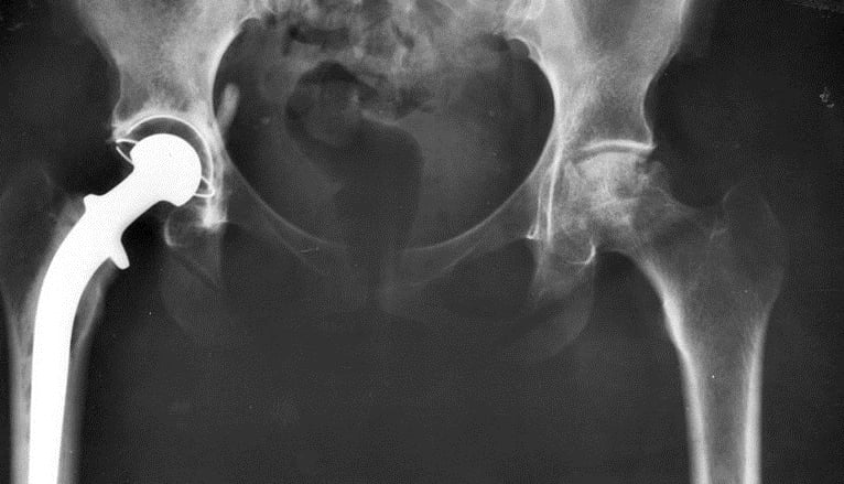 Dr.Rajinikanth's ortho clinic Hip joint infection