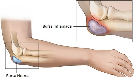 bursite, dor da bursa, bursa, dor articulação