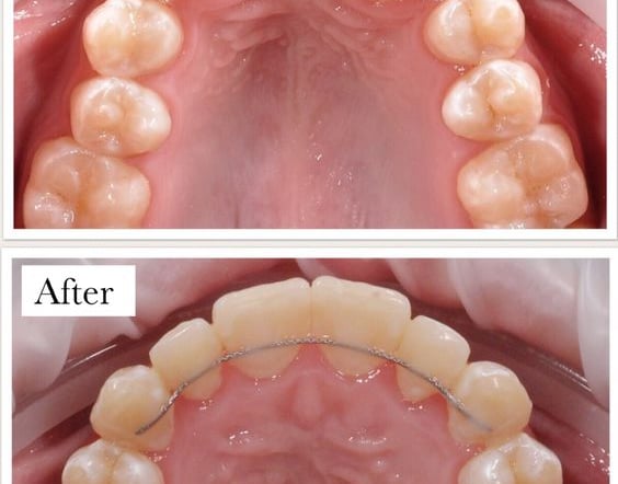 Ortho treatment/Braces for front teeth in  in white castle dental clinic katraj pune