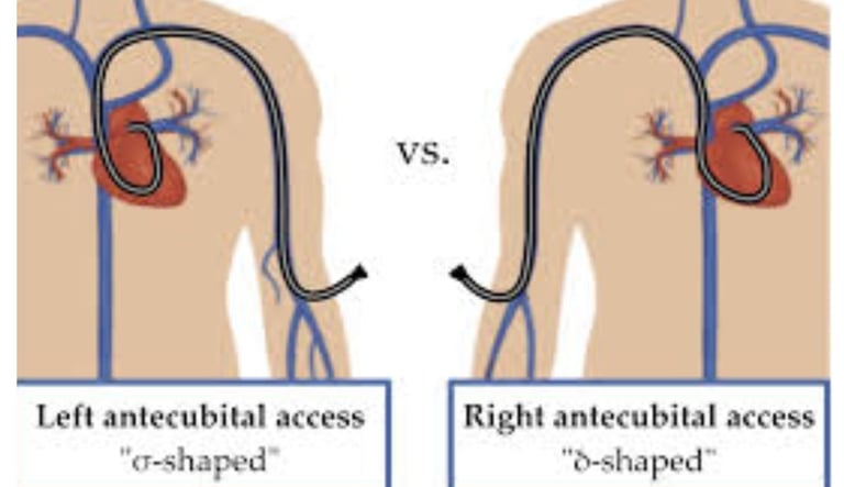 Cardiac Catheterization Why Every Case Is Followed by a Stent (3)