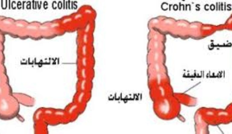 مرض كرون