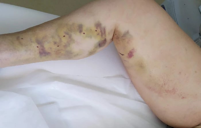 a person with a bruised leg and a wound on their arm