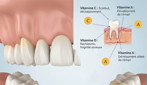 Carences en Fer et en Vitamines sur les dents et gencives, conséquences hygiene-precision.com