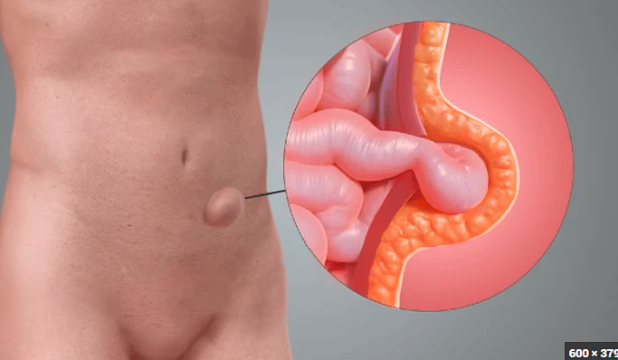 Imagem ilustrativa Hérnia de Spiegel