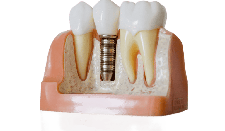 Modelo dental en corte transversal que muestra un tornillo de implante dental titanio entre dientes