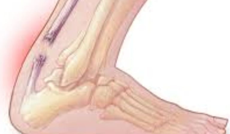 Achilles Tendon Injury : Broad Overviews