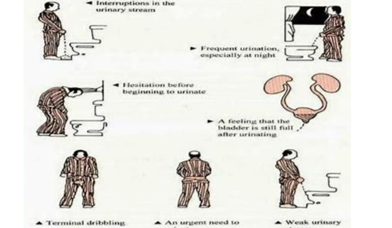 prostatitis