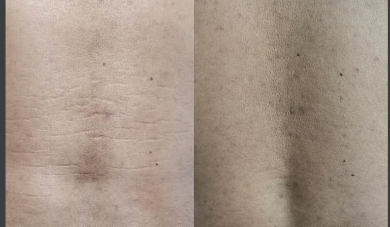 Avant et après : atténuation des vergetures masculines dans le dos.