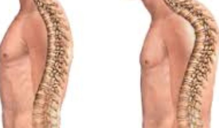 🦴❄️ Kyphosis and Kyphoscoliosis The Only Hope – Cold Water & Fasting Therapy 🍽️💧