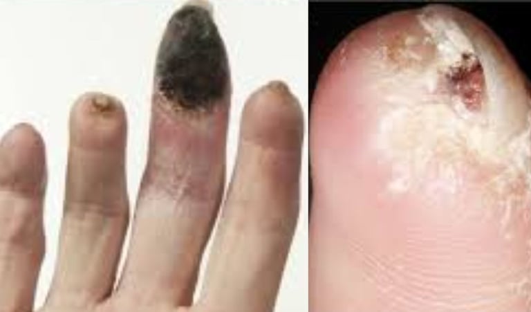 Painful Digital Ulcers : role of Role of Fasting and Cold Water