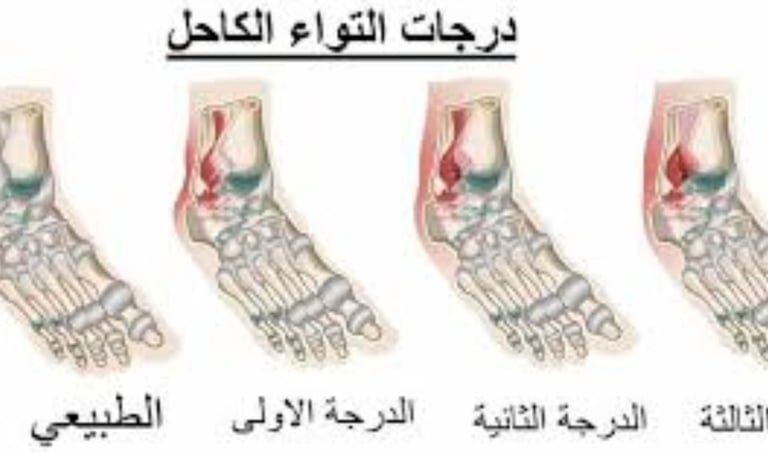 درجات التواء الكاحل