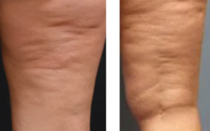 le massage brésilien : un massage anti cellulite